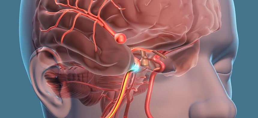 Brain Aneurysm Treatment in Pune